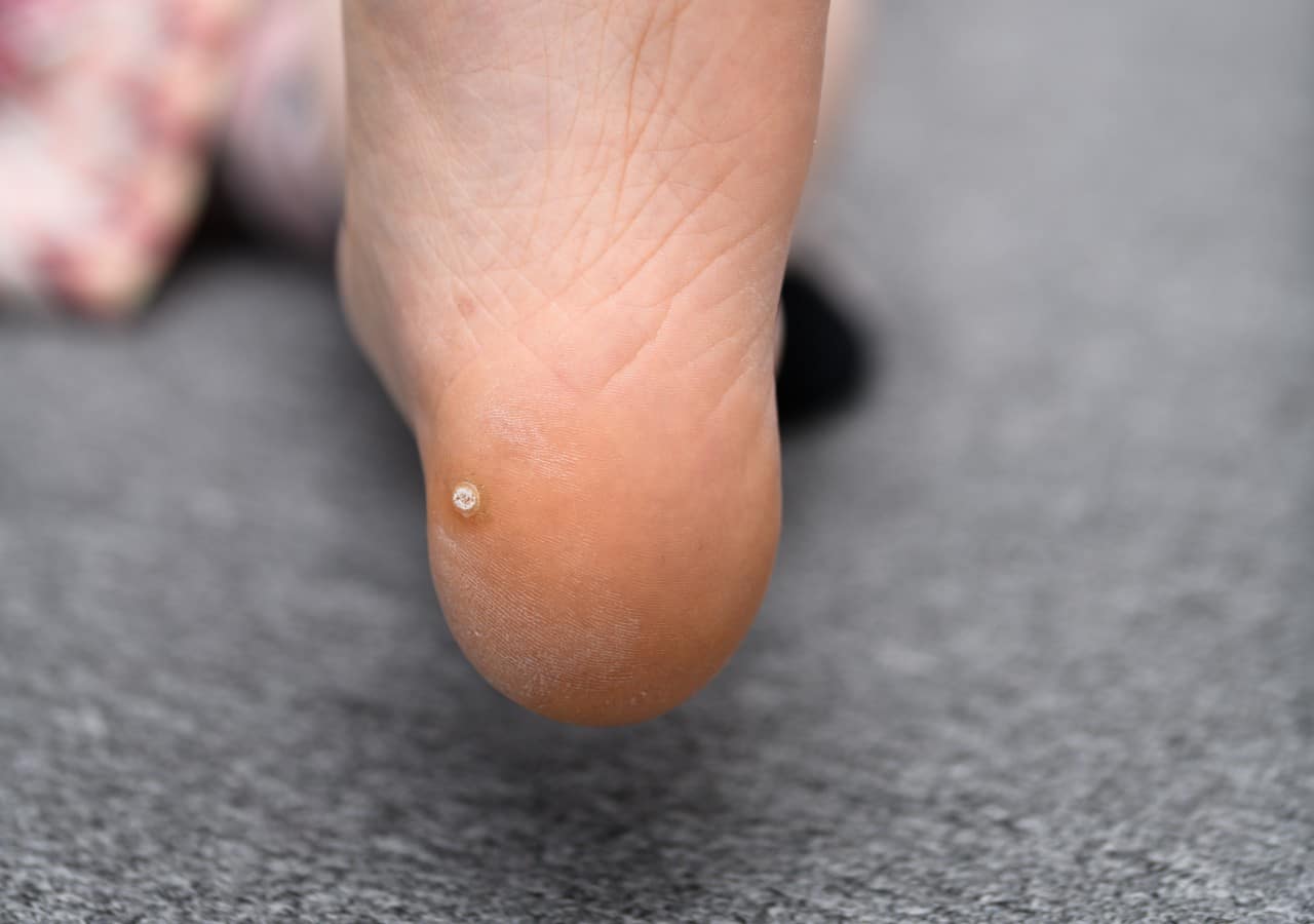 wart on the bottom of a girls foot