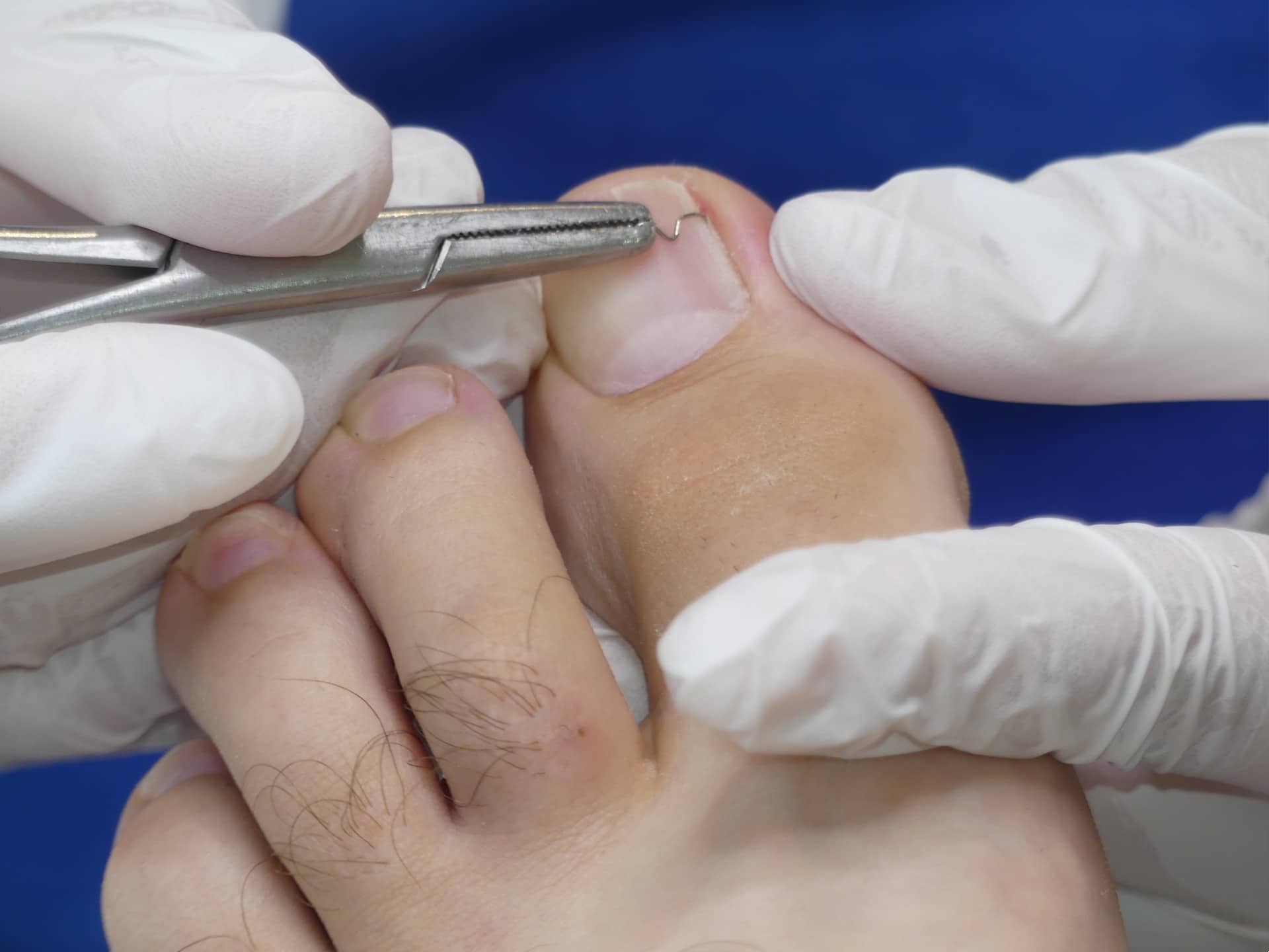 a doctor treating an ingrown toenail