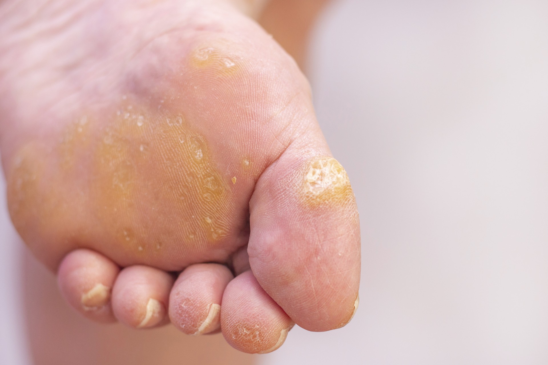 If there is one “industry” that will likely persist forever, it’s the constant stream of “home remedies” people claim for a variety of ailments – including plantar warts. We’ll come right out and say it now: the “miraculous” methods for treating plantar warts at home you have heard about are not scientifically verified. In fact, there’s little evidence that they work. We provide professional, proven treatment for you. So, why do “home remedies” continue to persist despite lack of evidence? There are several reasons. Warts Went Away – But Was it the Home Remedy? Plantar warts are caused by a virus – specifically, certain strains of the human papillomavirus (HPV). The virus invades the upper layers of the skin and creates the rough, grainy, bumpy patches you are likely familiar with. The virus can thrive for some time, but eventually most cases will resolve on their own. This can take time, though – up to 2 years or longer in some cases. So how do home remedies play into this? If one has been trying various home remedies and their plantar warts start to disappear, they may assume that this treatment finally “did the trick.” That only seems natural to believe. However, correlation does not always equal causation. There is a very good chance that the warts were already starting to fade away on their own, with or without the use of the home remedy. But if someone believes their remedy was responsible (and we are not blaming them for that), they may tell everyone about it, and others may try it until it “works” for them, too. It’s easy to unintentionally spread misinformation this way.