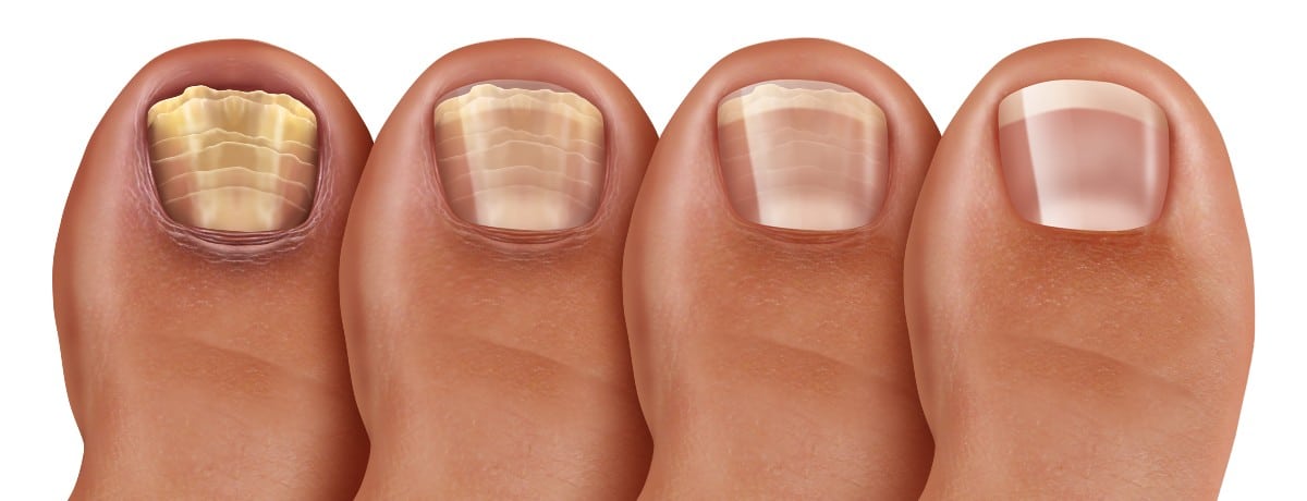 Toenail fungus and it's effects on nails