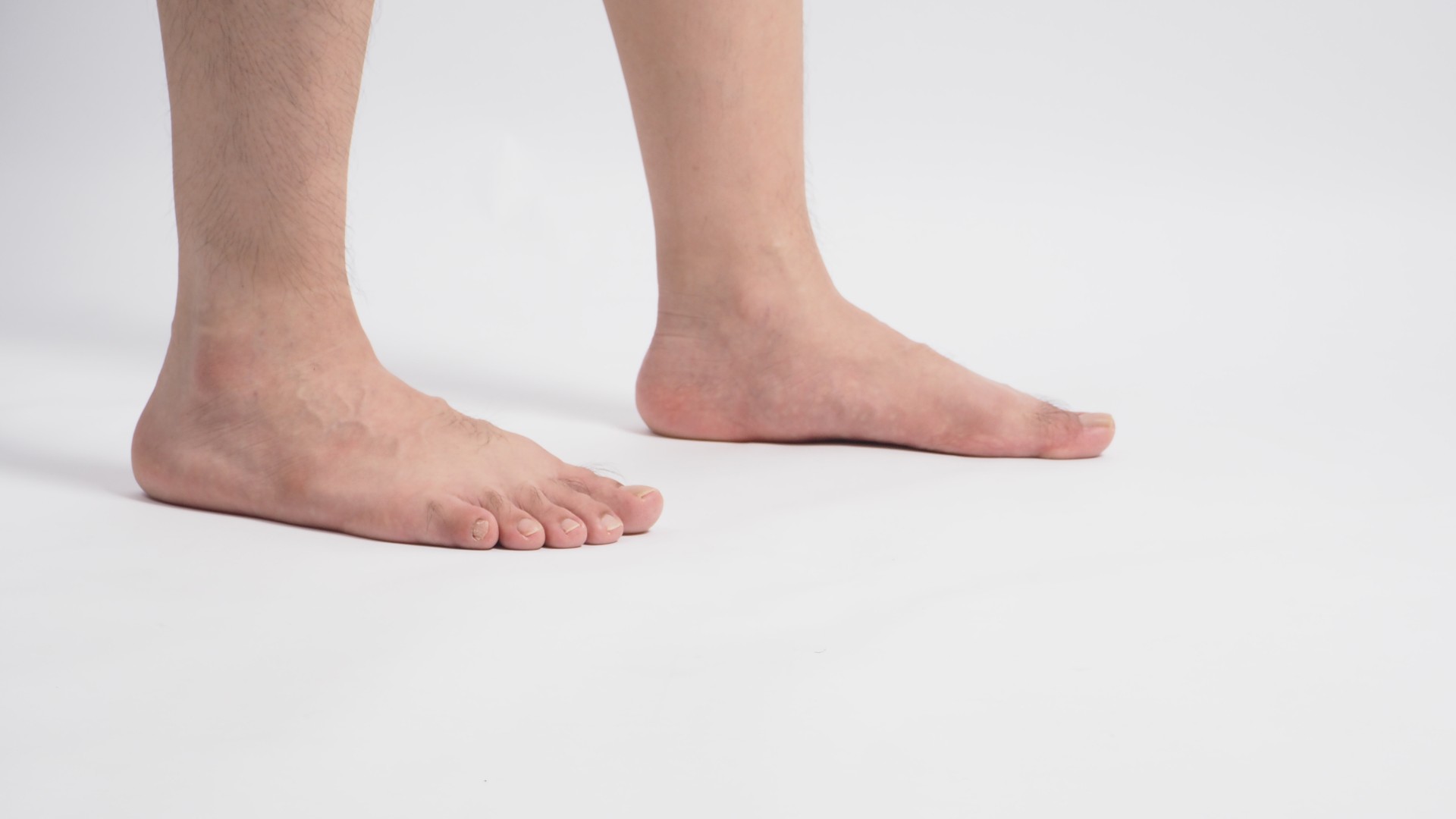a close up of a person's feet who has a flat foot condition