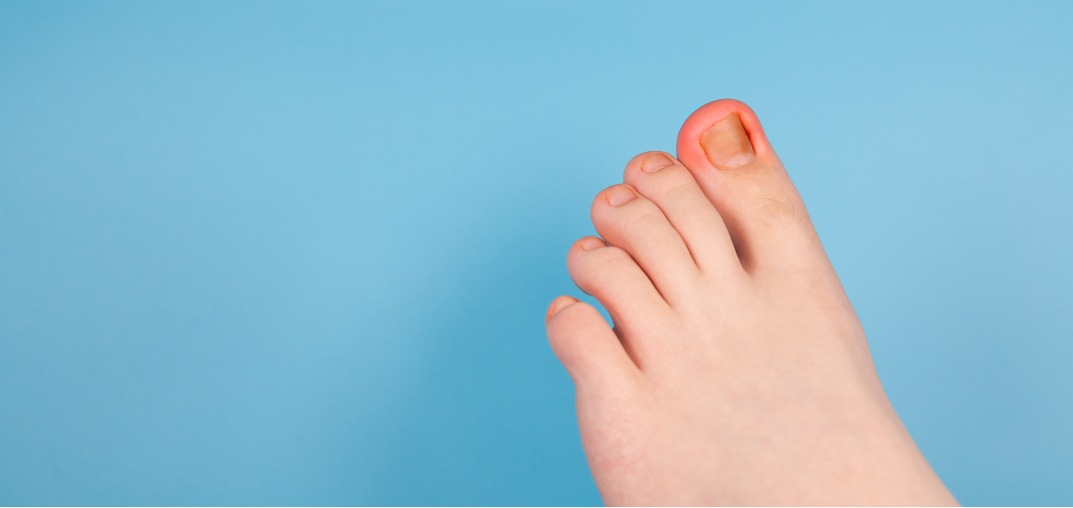 does-ingrown-toenail-surgery-hurt-midwest-podiatry-centers