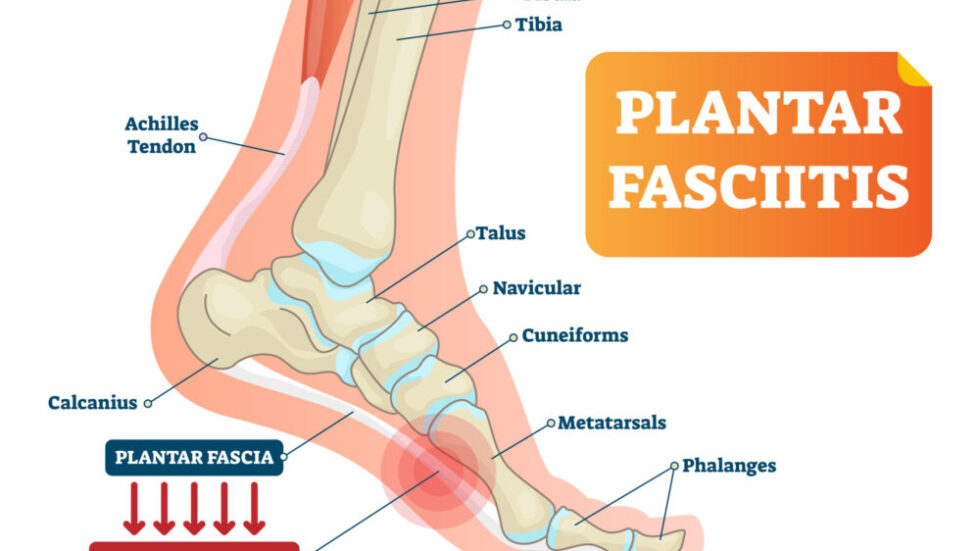 What are My Treatment Options for Plantar Fasciitis? // Midwest