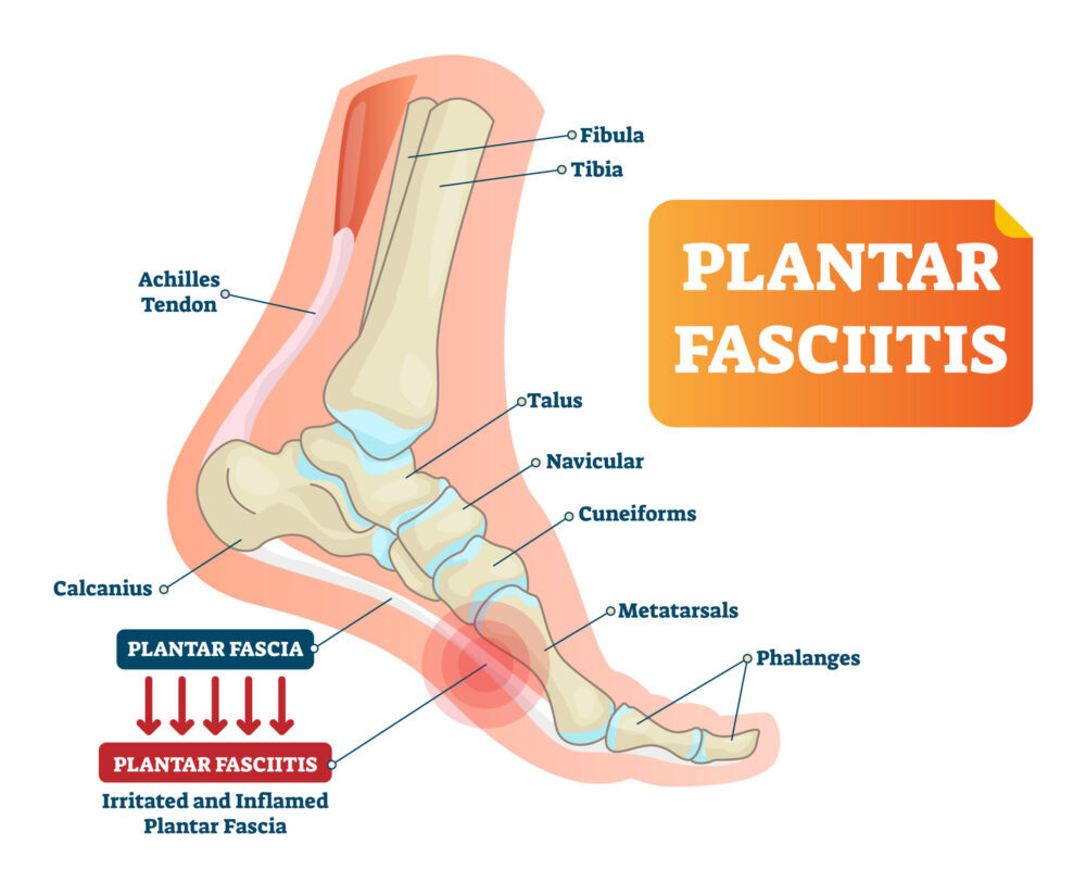Plantar fasciitis explained