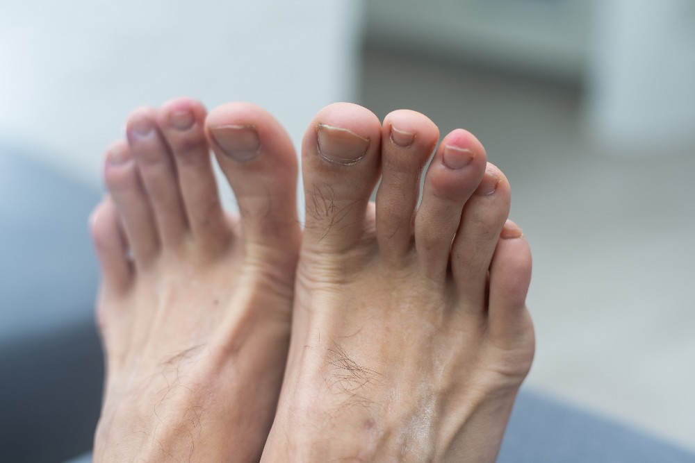 Feet after fungal toenails are treated and clear