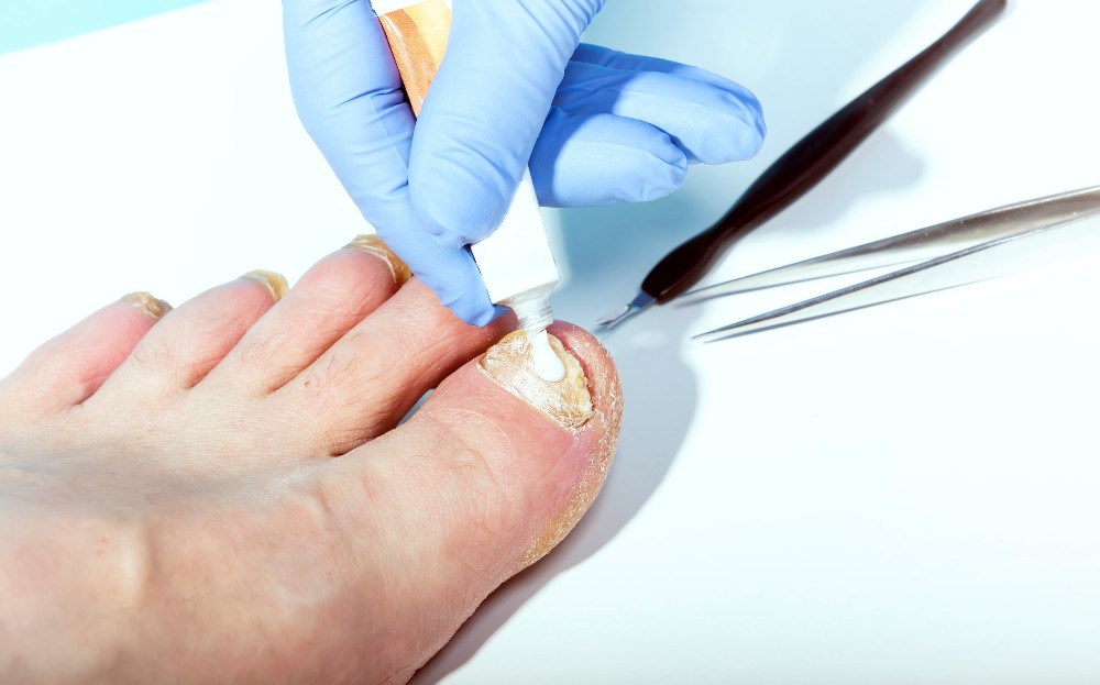Topical medication being put on fungal toenails for treatment