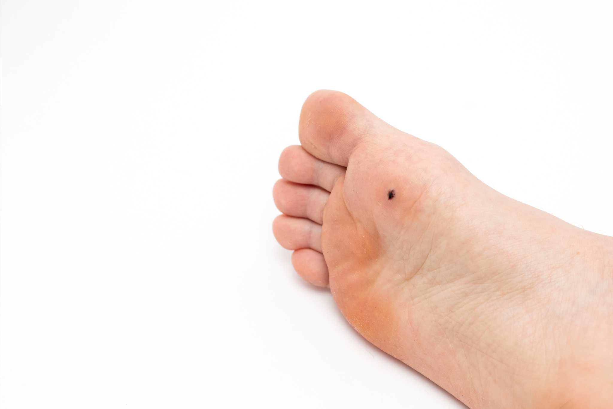 Foot with black plantar wart