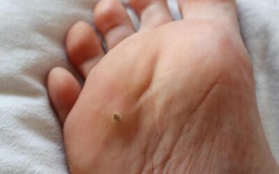 A Guide to the Swift Treatment for Plantar Warts