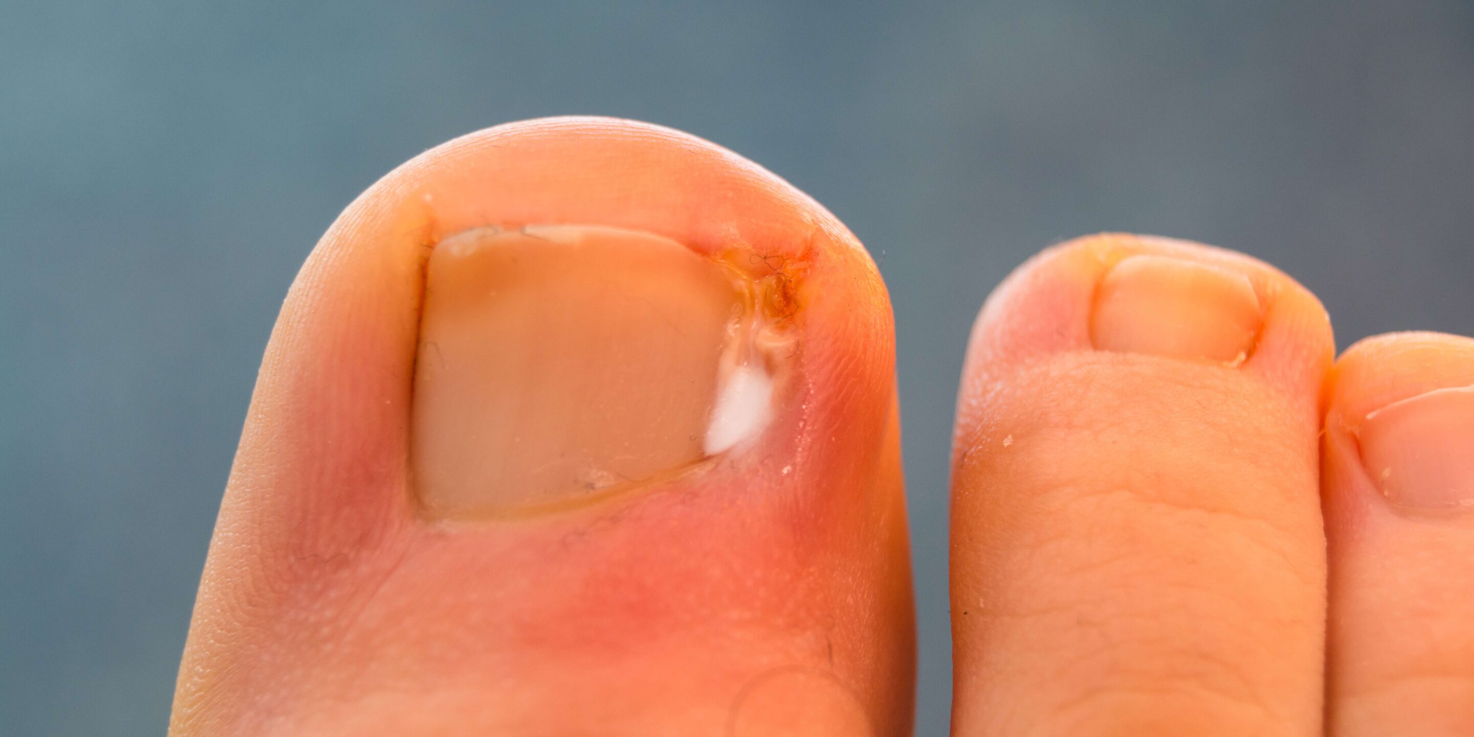 Close up of infected ingrown toenail on big toe