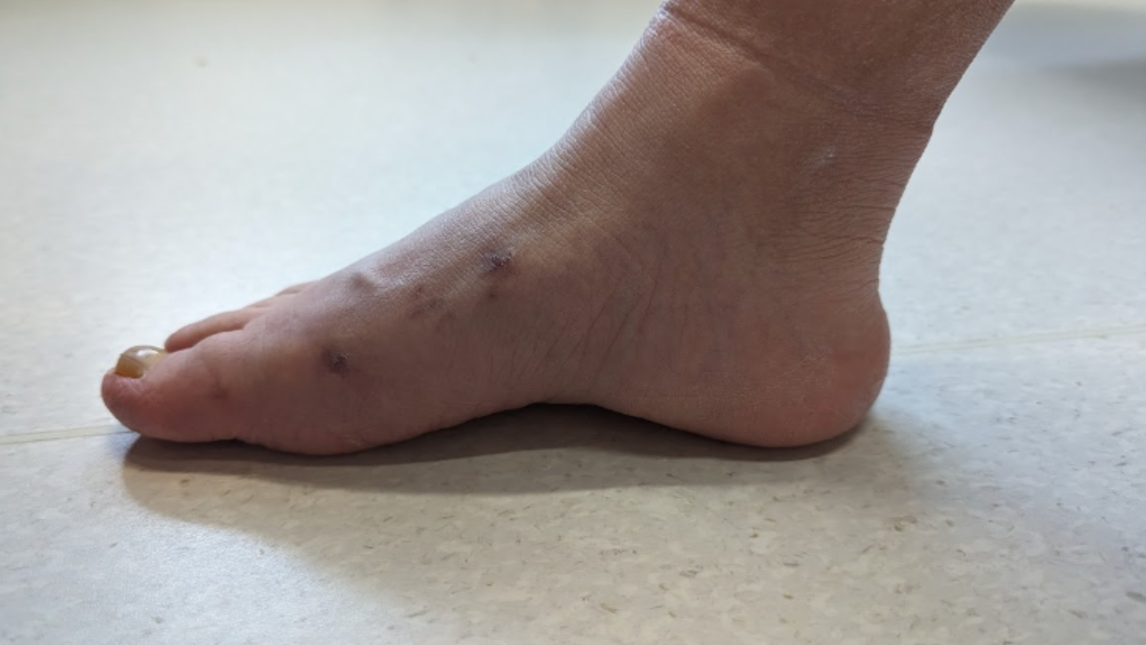 Picture of foot post op for bunions