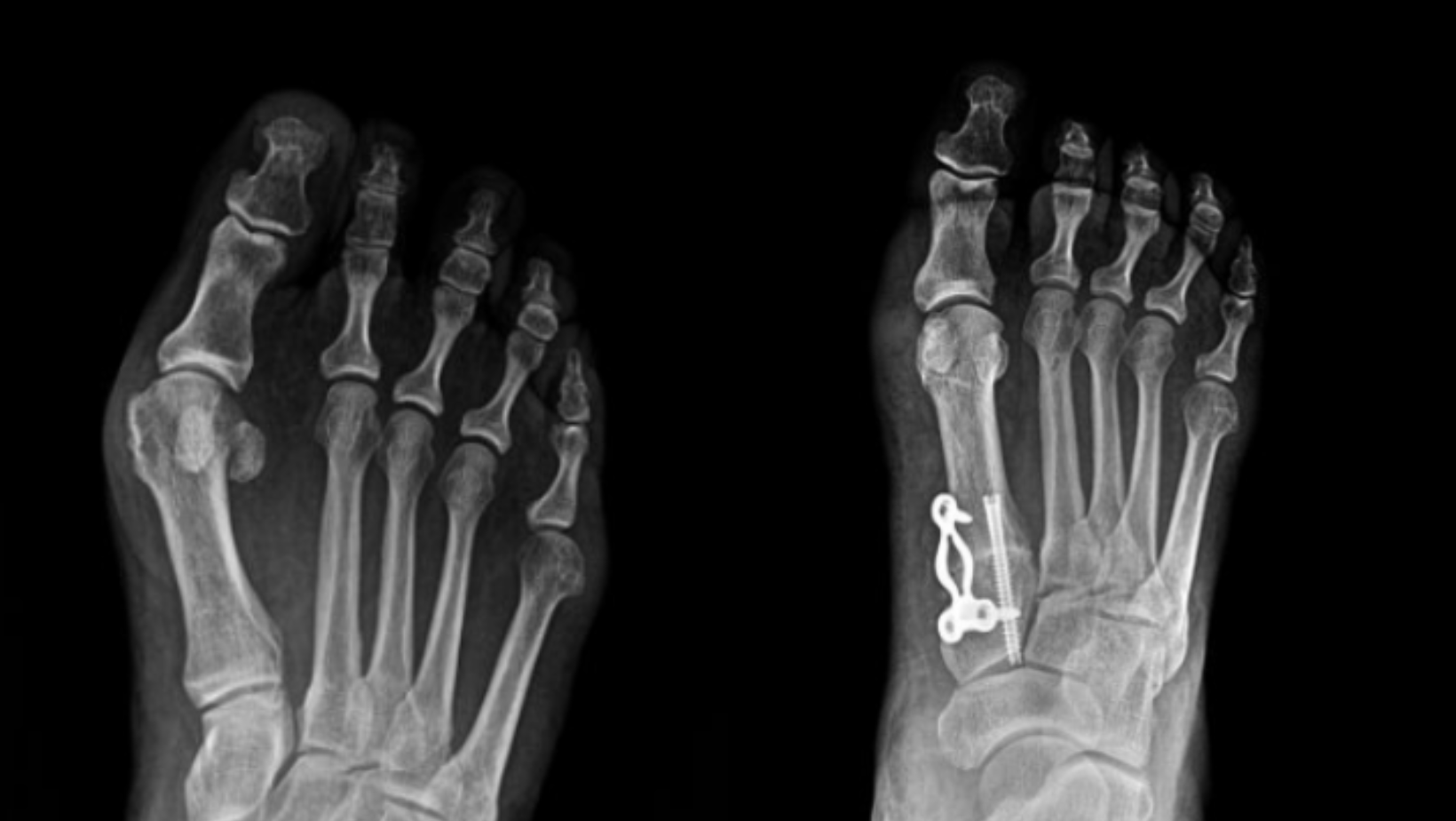 Bunion Before and After Surgery X-Ray 2