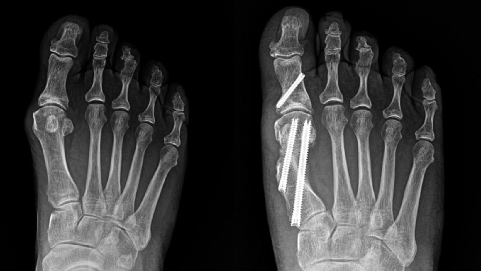 Bunion Before and After Surgery X-Ray