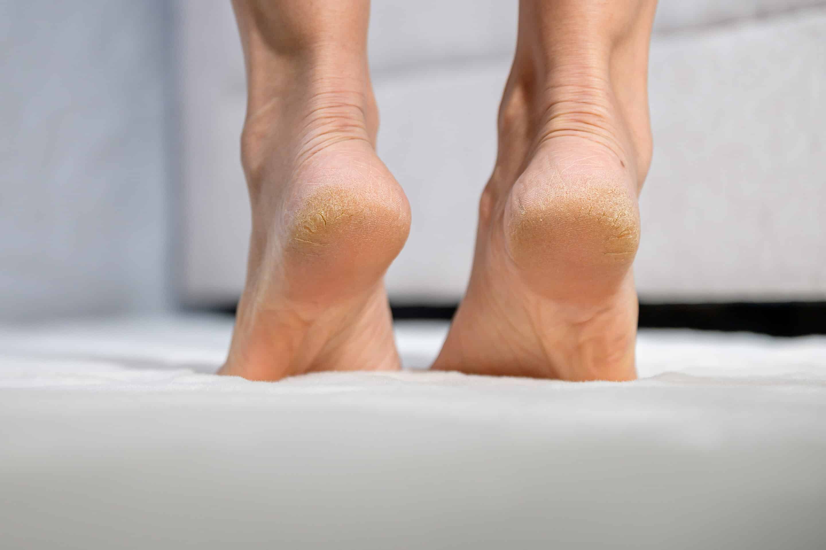 A close-up of human heels with cracked and dry skin, showing callus and rough texture. Concept of foot care, cracked heel problem, dermatology, healthcare, skin treatment, and wellness.