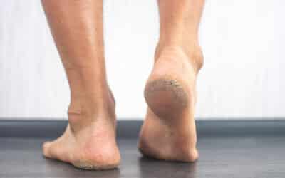 Why Heel Cracks Are Worse in Cold Minnesota Weather