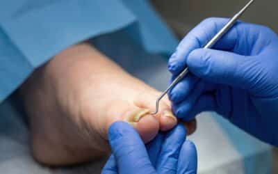 How to Know If Toenail Fungus Is Dying | Midwest Podiatry Centers